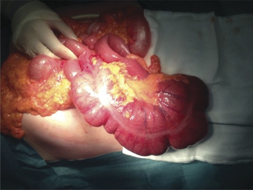 Freely mobile, distended caecum found on opening.