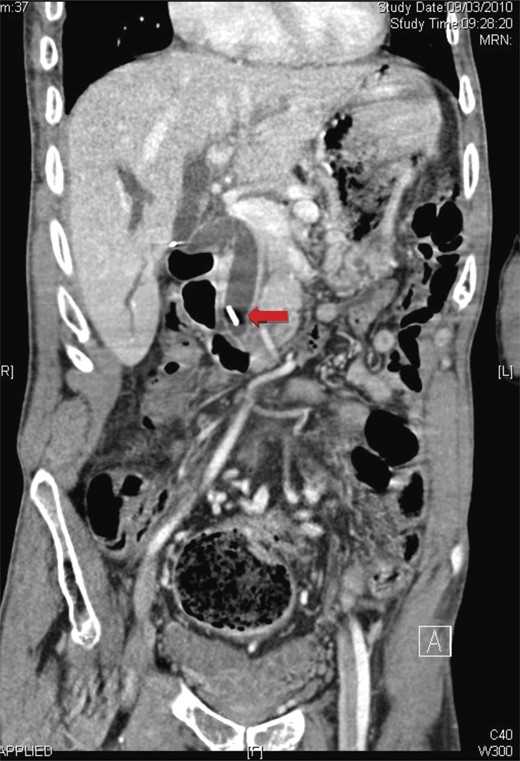A coronal view of magnetic resonance cholangiopancreatography showing the presence of a surgical clip and common bile duct dilatation.