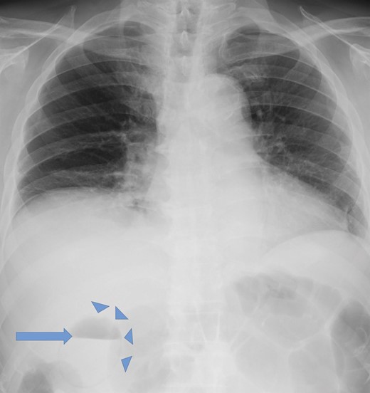Up-right chest X-ray demonstrating air in the gallbladder (arrow) and in its wall (arrowheads).