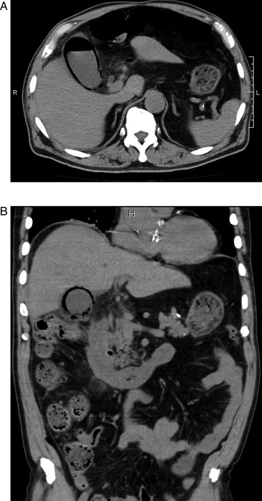 (A and B) Abdominal computed tomographic scans of axial and coronal views revealing emphysematous changes in the gallbladder wall and air in the gallbladder.