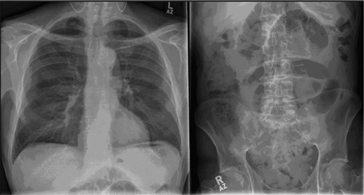 Plain film of the chest and abdomen: the chest X-ray shows features suggestive of air under the diaphragm, while the abdominal film shows dilated loops of small and large bowel with air in the rectum, highly suggestive of ileus.