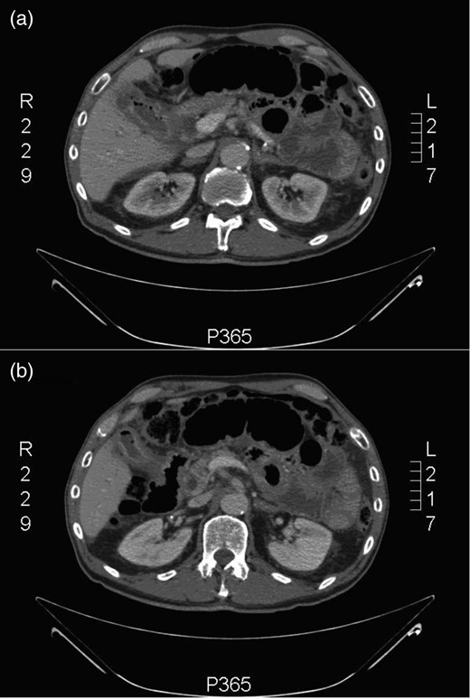 CT abdomen + pelvis: (a) inflammation of the gallbladder and (b) a very closely adherent gallbladder to the second part of the duodenum (D2).