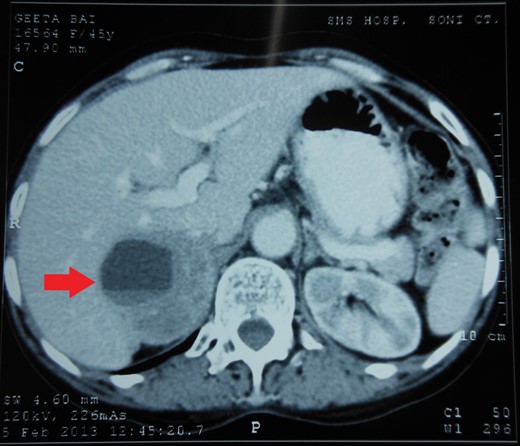 CECT abdomen showing an inhomogeneously dense right suprarenal mass (TRANSVERSE SECTION).