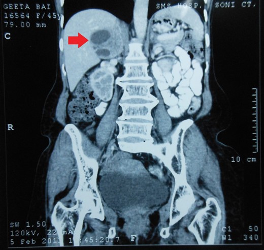 CECT abdomen showing an inhomogeneously dense right suprarenal mass (CORONAL SECTION).