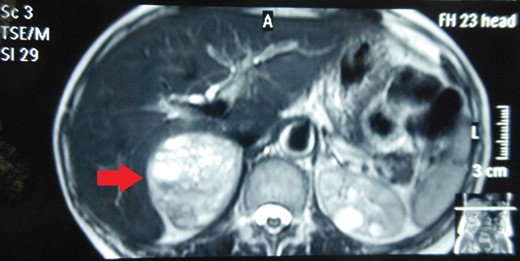 MRI abdomen showing a hyperintense right suprarenal mass (TRANSVERSE SECTION).