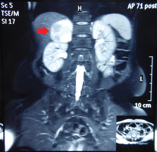 MRI abdomen showing a hyperintense right suprarenal mass (CORONAL SECTION).