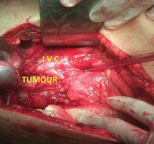 Intra-operative photograph of right adrenal tumour abutting the IVC.