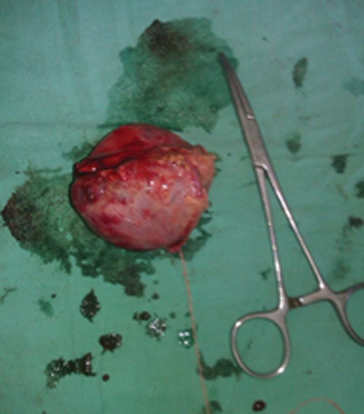 Post-operative specimen.