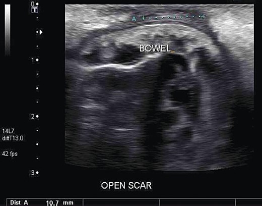 Ultrasound of the patient's abdominal wall, revealing a large defect with small bowel herniation adjacent to the skin.
