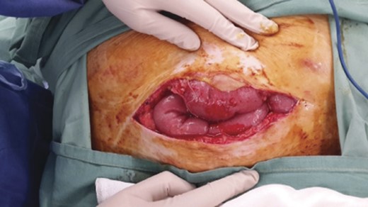 Dehiscence of the rectus sheath, resulting in small bowel herniation.