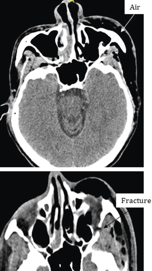 Different levels of head imagining showing fracture of the floor of the orbit and subcutaneous air.
