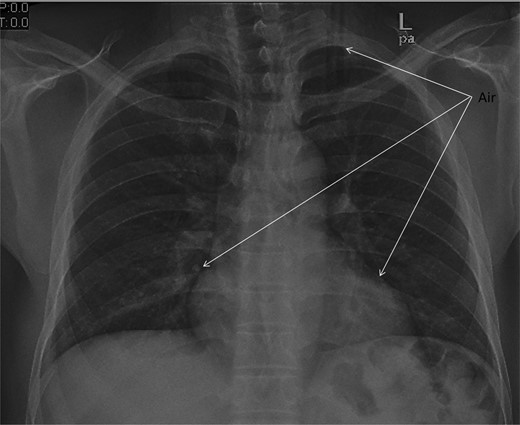 Chest X-ray shows the air extension in the chest.