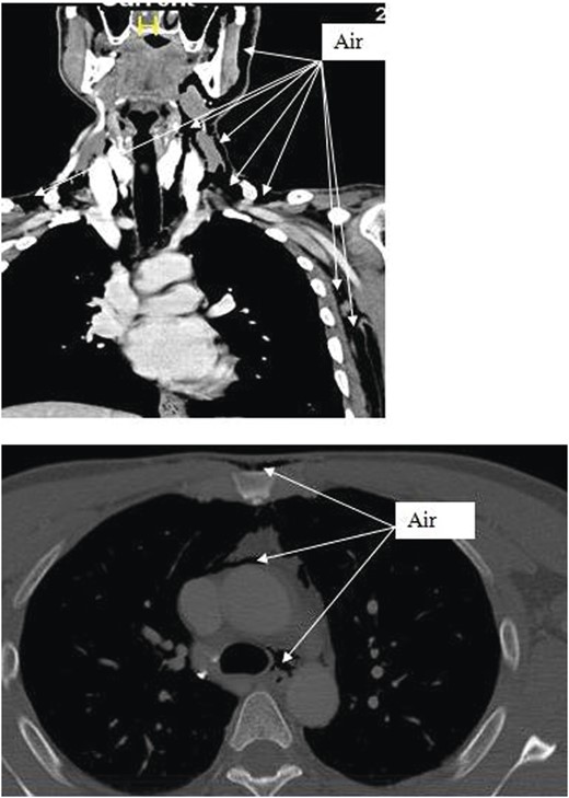 CT scan shows the extension of air from the face, neck and chest.