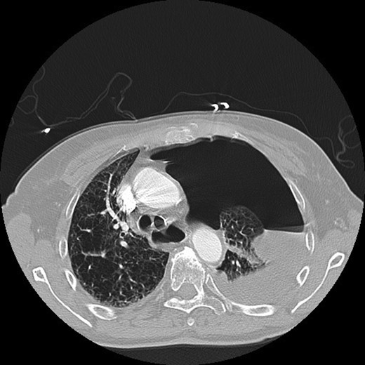 CT chest demonstrating left hydropneumothorax with mediastinal shift.