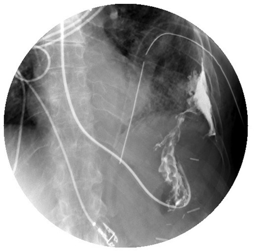 Upper GI study demonstrating contrast administered via nasogastric tube with extravasation into the pleural space.