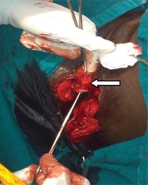 Vagina carefully separated from the anterior rectal wall (arrow); gauze swab in the right and left ischioanal fossa, respectively.