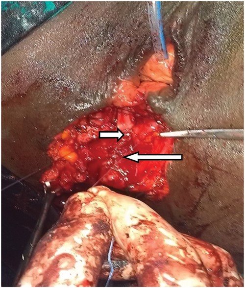 IAS plication (long arrow) extending to the plicated levator ani (short arrow) (forceps on the separated external sphincter, urethral catheter in situ).