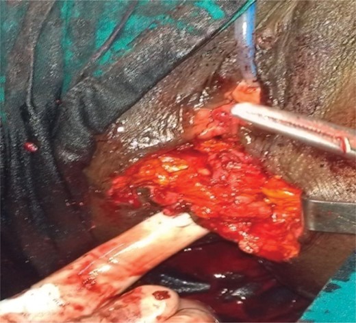 Anterior external sphincteroplasty (covered by isciorectal fat; finger in anal canal).