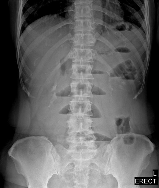 Upright abdominal radiograph showing multiple air-fluid levels, suggestive of possible distal bowel obstruction.