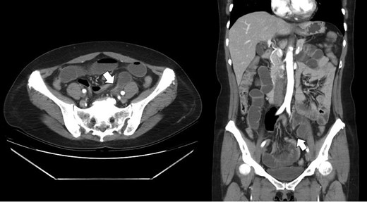 Contrast enhanced CT showing the transitional zone (white arrow) between dilated to collapsed loops in the left lower abdomen.