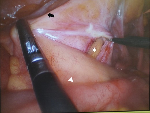 After reducing the incarcerated ileum (white arrowhead), the defect (asterisk) in the lateral leaf of the sigmoid mesocolon (black arrow) is seen.