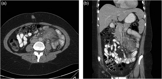 (a) Transverse CT image with the ill-defined tumour in the left side of the patient. (b) Coronal CT image showing the same ill-defined tumour.