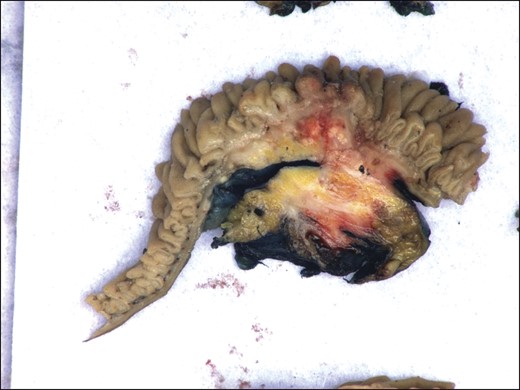 Macroscopic appearance of the tumour.