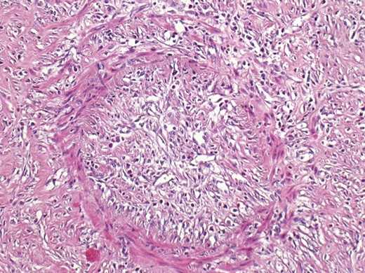 Microscopic appearance with the presence of inflammatory cells, mainly lymphocytes.