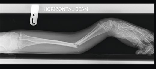 Pre-operative lateral radiograph showing dorsally angulated both-bone forearm greenstick fracture.