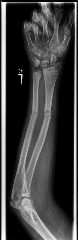 Pre-operative anteroposterior (AP) radiograph showing level of fracture at the junction of proximal two-thirds and distal one-third.
