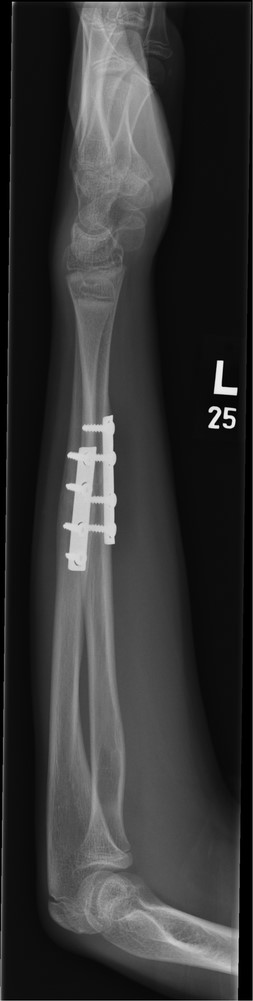 Three months post-operative lateral radiograph showing radiological union.