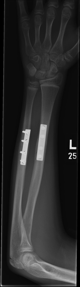Three months post-operative AP showing radiological union.