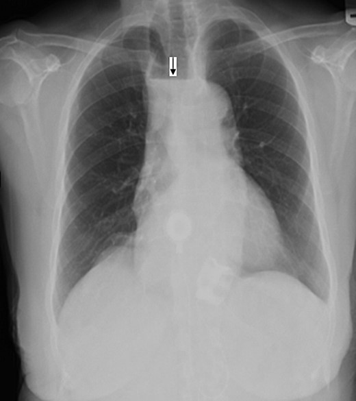 Anterio-posterior CXR views demonstrate the shadow of a dilated esophagus and air fluid level (black arrow).