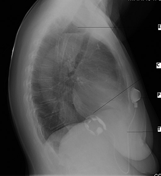 Lateral CXR view demonstrates dilated esophagus and fluid air level (E), contrast medium-filled inflatable inner cuff (C), connecting silicone tube (T) and subcutaneous sutured radiopaque access port (P).