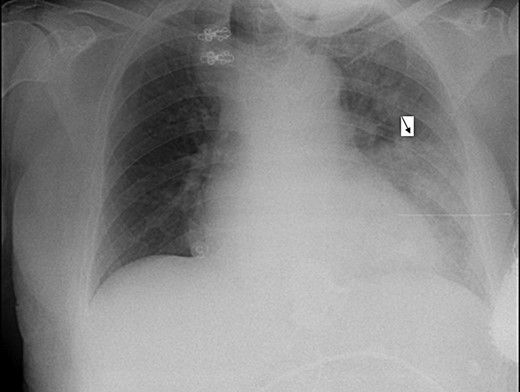 AP CXR demonstrates left lower lobe pneumonia (black arrow).