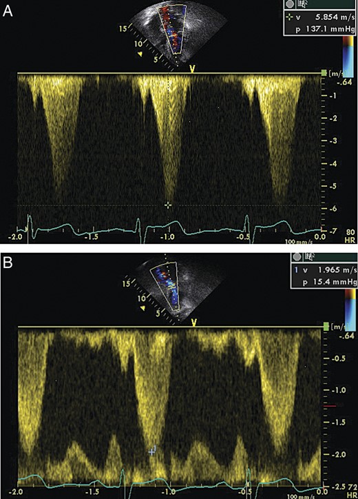 (A) Echocardiogram demonstrating LVOT flow parameters at rest. (B) Echocardiogram demonstrating LVOT flow parameters during Valsalva maneuver, note the increase in amplitude and the ‘dagger-shaped’ flow pattern demonstrating the dynamics of LVOT obstruction.