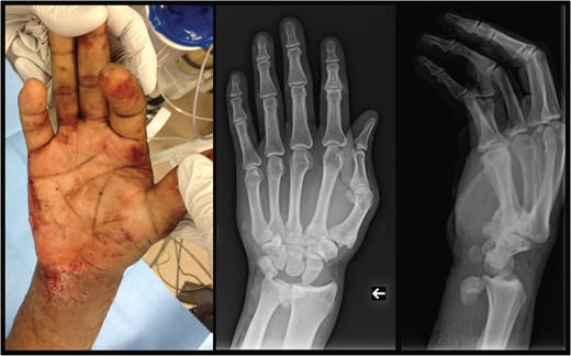 Left: preoperative gross depiction of injury. Center: antero-posterior view of the right wrist, demonstrating displacement of the lunate to a position just radial to the ulna. Right: lateral view of the right wrist, demonstrating displacement of the lunate anterior to the ulna/radius. Carpometacarpal subluxation is also noticed.