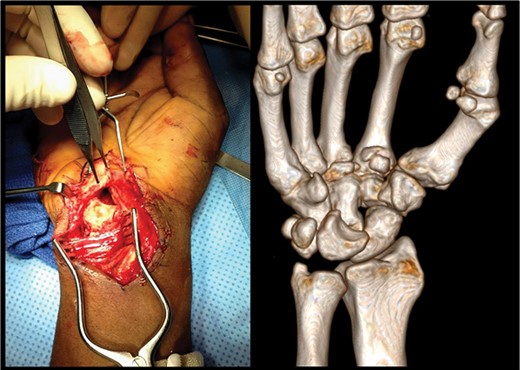 Left: intraoperative image demonstrating the dislocated lunate sitting anterior to the carpal tunnel prior to operative reduction. Right: preoperative volar view of a three-dimensional CT reconstruction of a right wrist. Dislocation of the lunate from the carpus is noted.