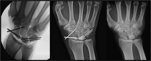 Left: intraoperative image demonstrating K-wires supporting the lunate. Center: postoperative image at 10 months demonstrating the lunate still in proper position with retained hardware. Right: postoperative image at 10 months demonstrating proper positioning of the lunate after removal of hardware.