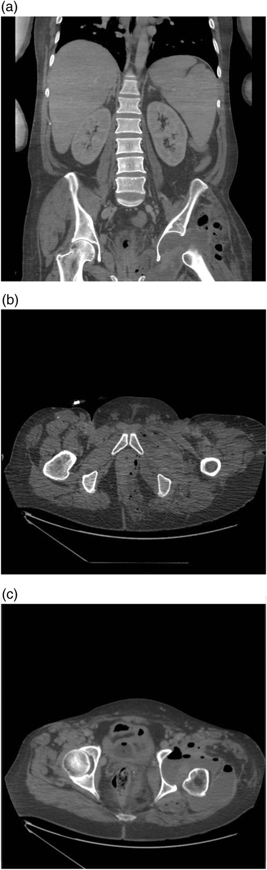 (a) Coronal slice from a CT scan of the abdomen and pelvis showing the left hip gridlestone with the presence of air in the joint space. (b and c) Axial images demonstrating air in the lower rectum with involvement of the left ischial fossa and passage along the obturator canal to the left hip joint.
