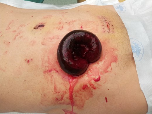 Gangrenous eviscerated small bowel in the 12-mm port site at the right iliac fossa.