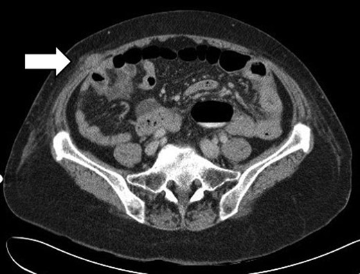 CT scan showing dilated small bowels and a transition point at an ileal herniation through the anterolateral abdominal wall in the right iliac fossa.