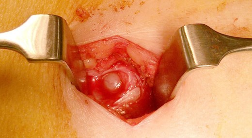 Richter's type hernia in the previous 12-mm port site.