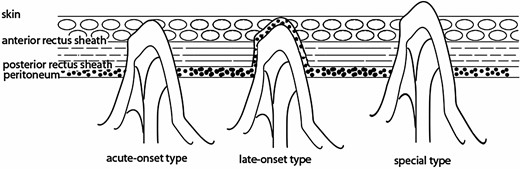Tonouchi's classification of trocar site hernias.