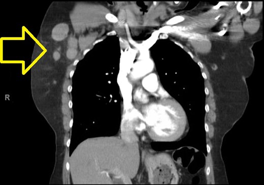 Chest CT showing lesion in the right breast and moderate right axillary lymphadenopathy.