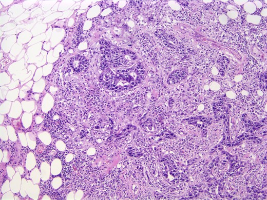 Photomicrograph: apocrine differentiation and inflammatory response.