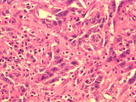Photomicrograph: large nuclei with eosinophilic cytoplasm and prominent nucleoli consistent with apocrine differentiation.