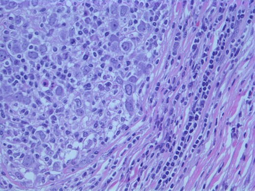 Photomicrograph: axillary lymph node with tumor invasion.