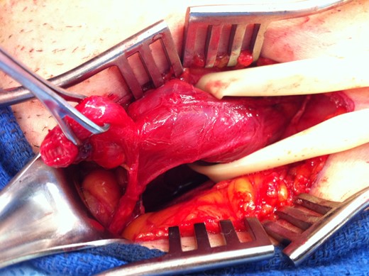 Left indirect inguinal hernia.