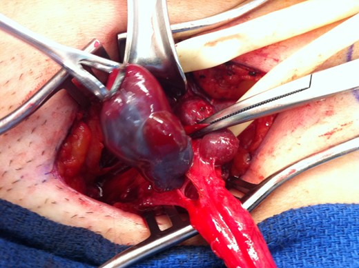 Purple cystic structure within the sac of an indirect inguinal hernia, travelling along the round ligament down towards the mons pubis.